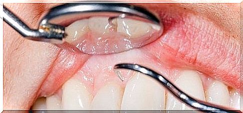 14 reasons why you suffer from bleeding gums