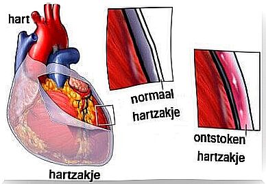 pericarditis