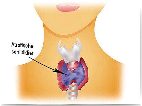 Atrophic Thyroid Gland