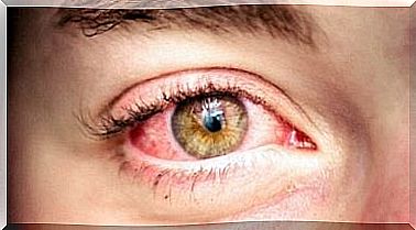 Red and watery eyes must be treated to get healthy eyes