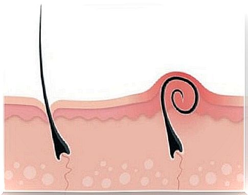 How to treat and prevent ingrown hairs?