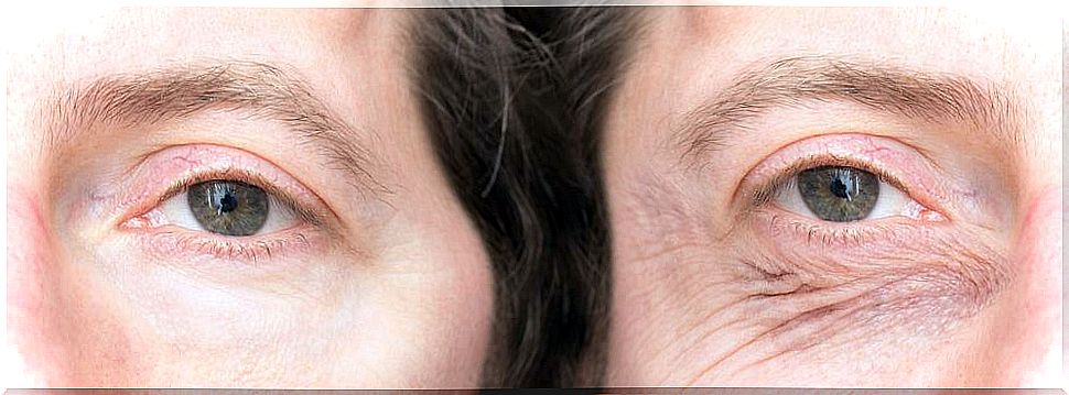 Learn more about drooping eyelids