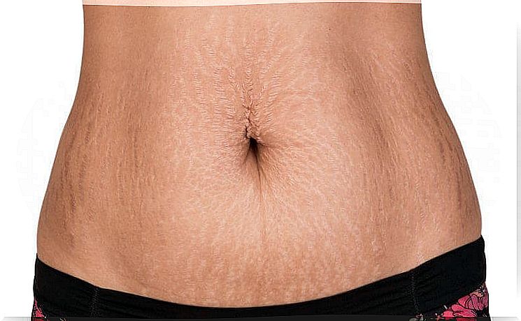 Natural remedies for stretch marks