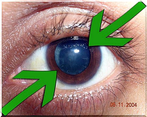 Natural treatment and prevention of cataracts