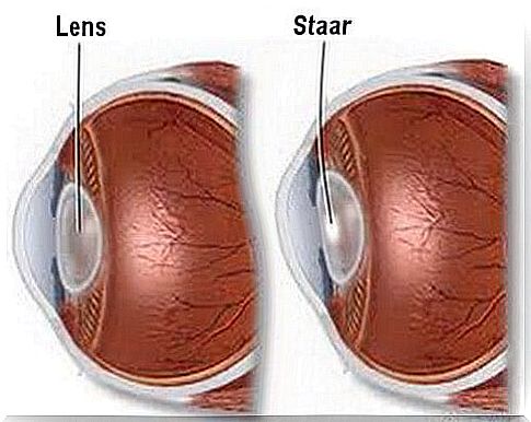 gray cataract