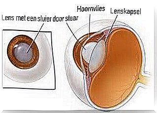 Gray cataract illustrated