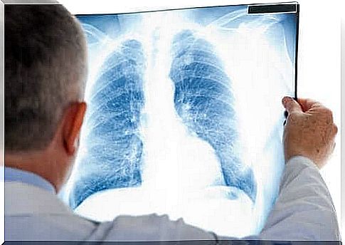 A Pulmonary Embolism: Symptoms and Treatment