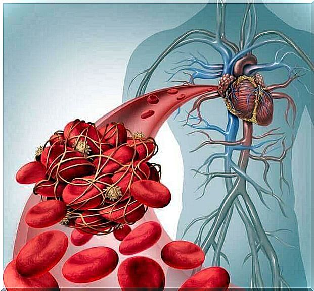 What is a pulmonary embolism