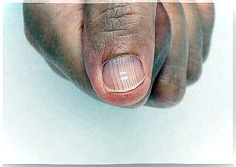 Stripes on the fingernails are signs of health problems