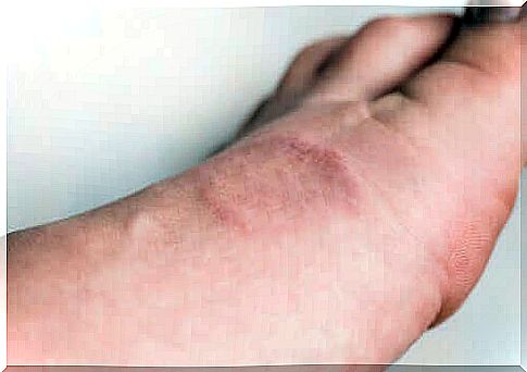 Symptoms and treatment of granuloma annulare