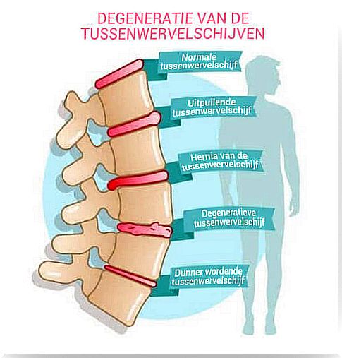 Symptoms of Degenerative Disc Disease