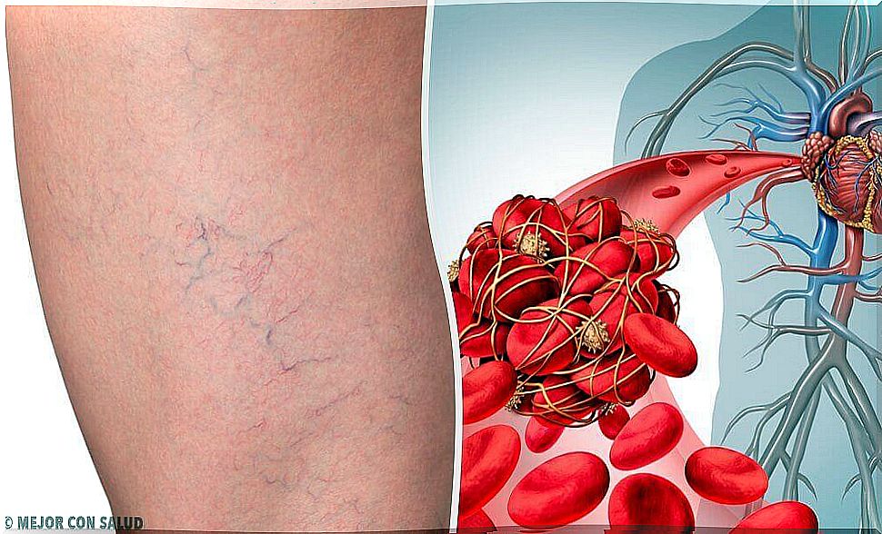 The 3 Best Home Remedies For Phlebitis Or Vein Inflammation