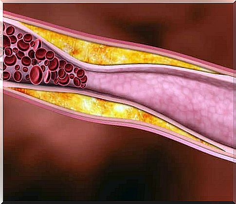 Cholesterol in the veins