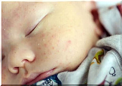 Treating Skin Problems In Babies Like Mountain And Baby Acne