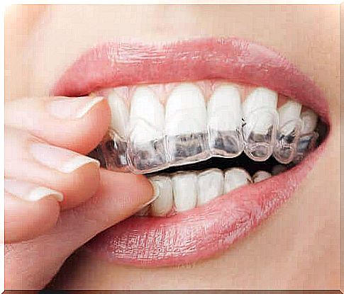 Clear aligners