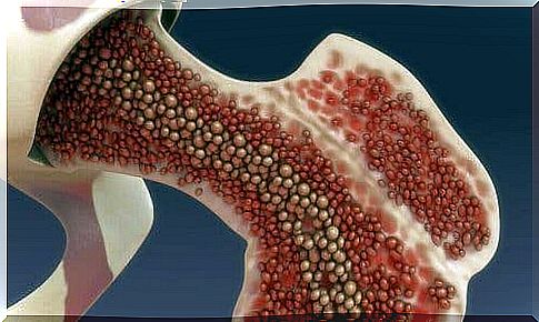 Bone marrow enlargement