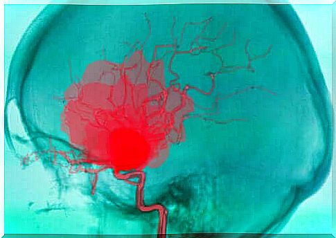 What exactly is an intracerebral hemorrhage?