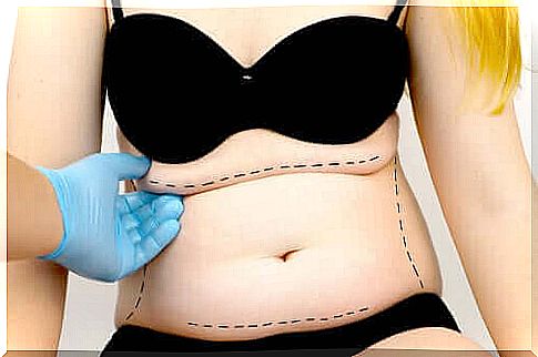 What is a tummy tuck or tummy tuck?