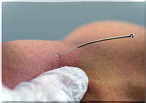 What is dry needling and is it effective?