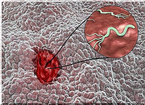 Damage to the gastric mucosa